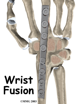 wrist_fusion_intro01