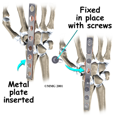 wrist_fusion_surg03