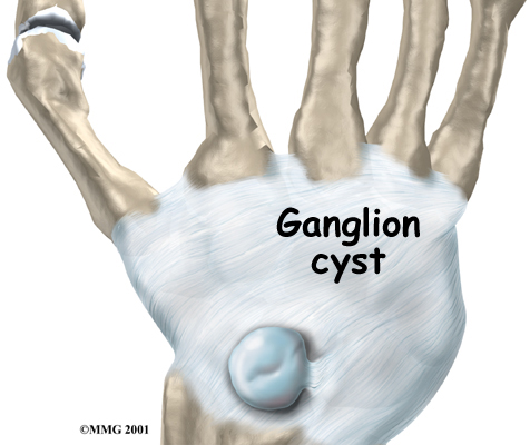 wrist_ganglion_intro01