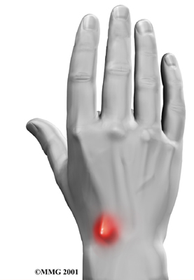 wrist_ganglion_symptoms01