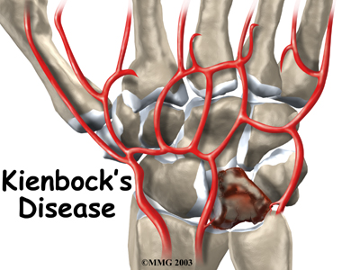 wrist_kienbocks_disease_intro01
