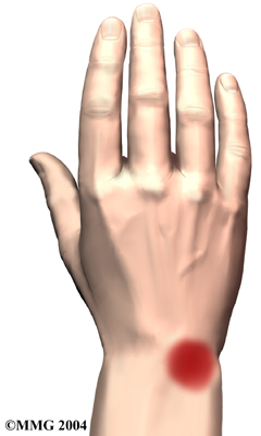 wrist_kienbocks_disease_symptoms01