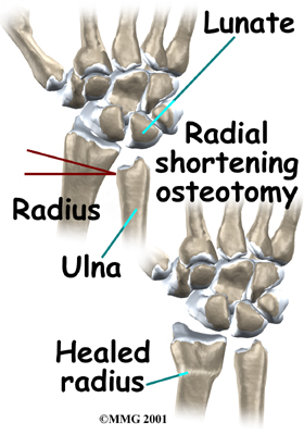 wrist_kienbocks_disease_treatment02