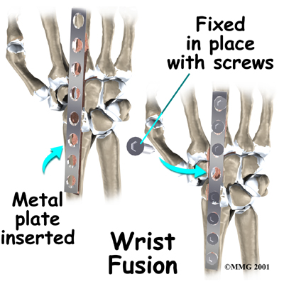 wrist_kienbocks_disease_treatment05