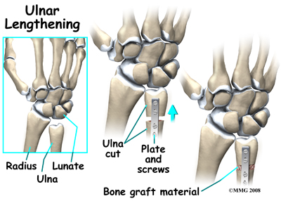 wrist_kienbocks_disease_treatment06
