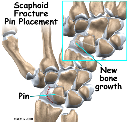 wrist_scaphoid_fracture_treatment03