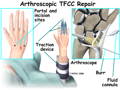 wrist_tfcc_surgery01