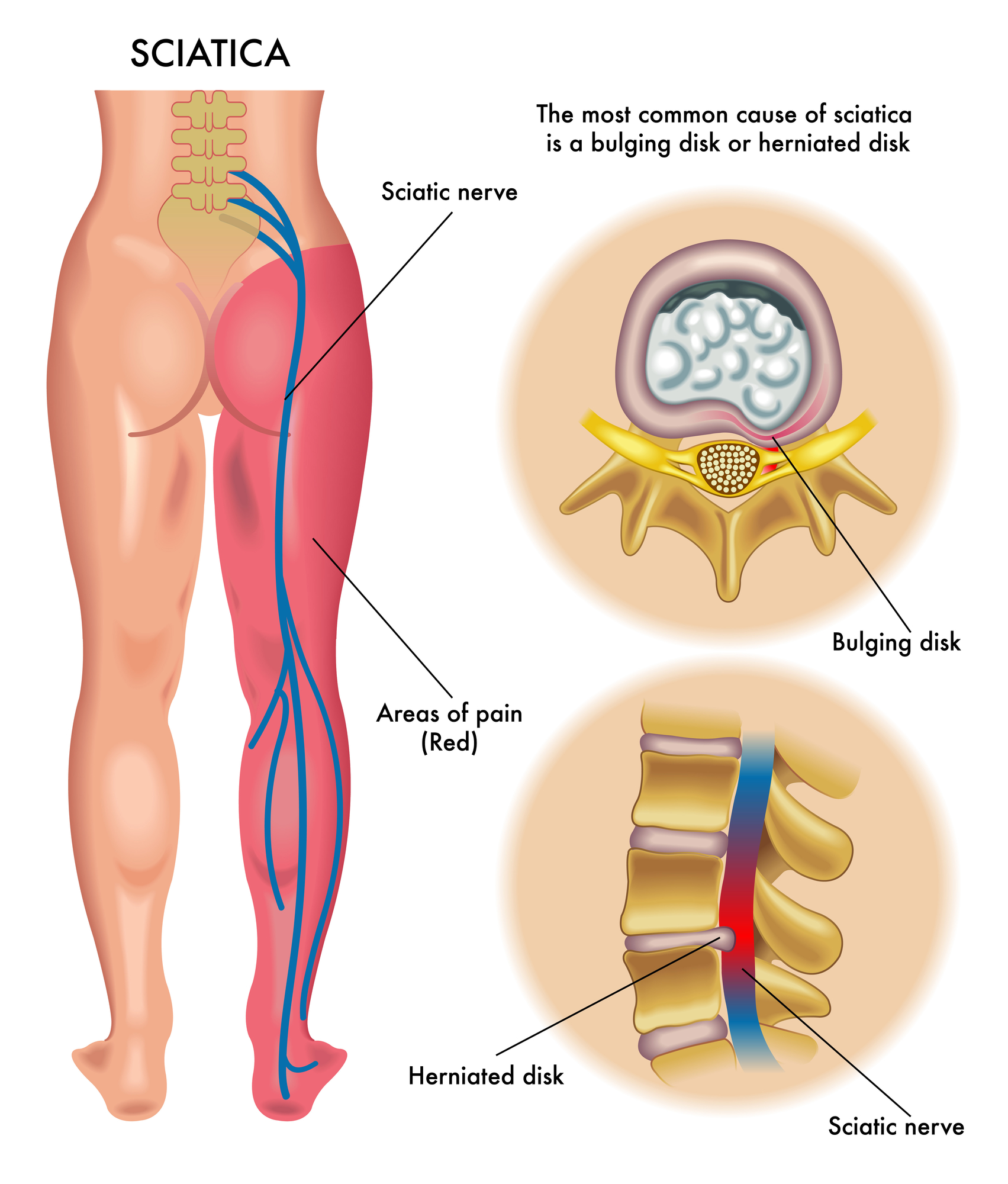 Sciatic Nerve Pain Diagram - Central Orthopedic Group