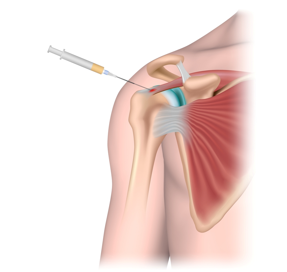 Injection for pain for rotator cuff injury