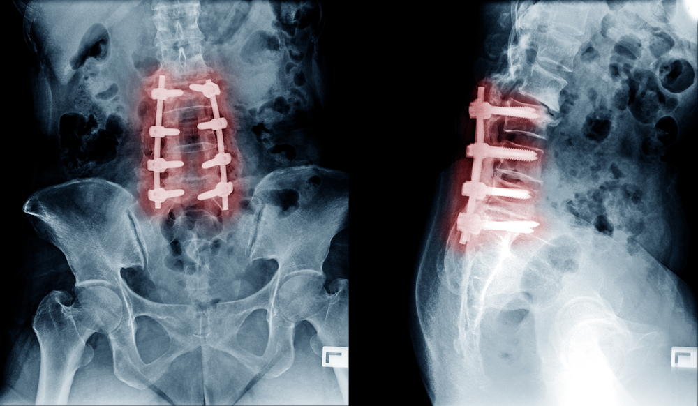 X-rays following spinal surgery