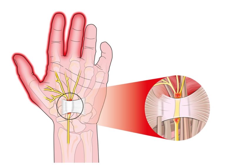 Carpal Tunnel Syndrome How a Hand Surgeon Can Help Othopedics