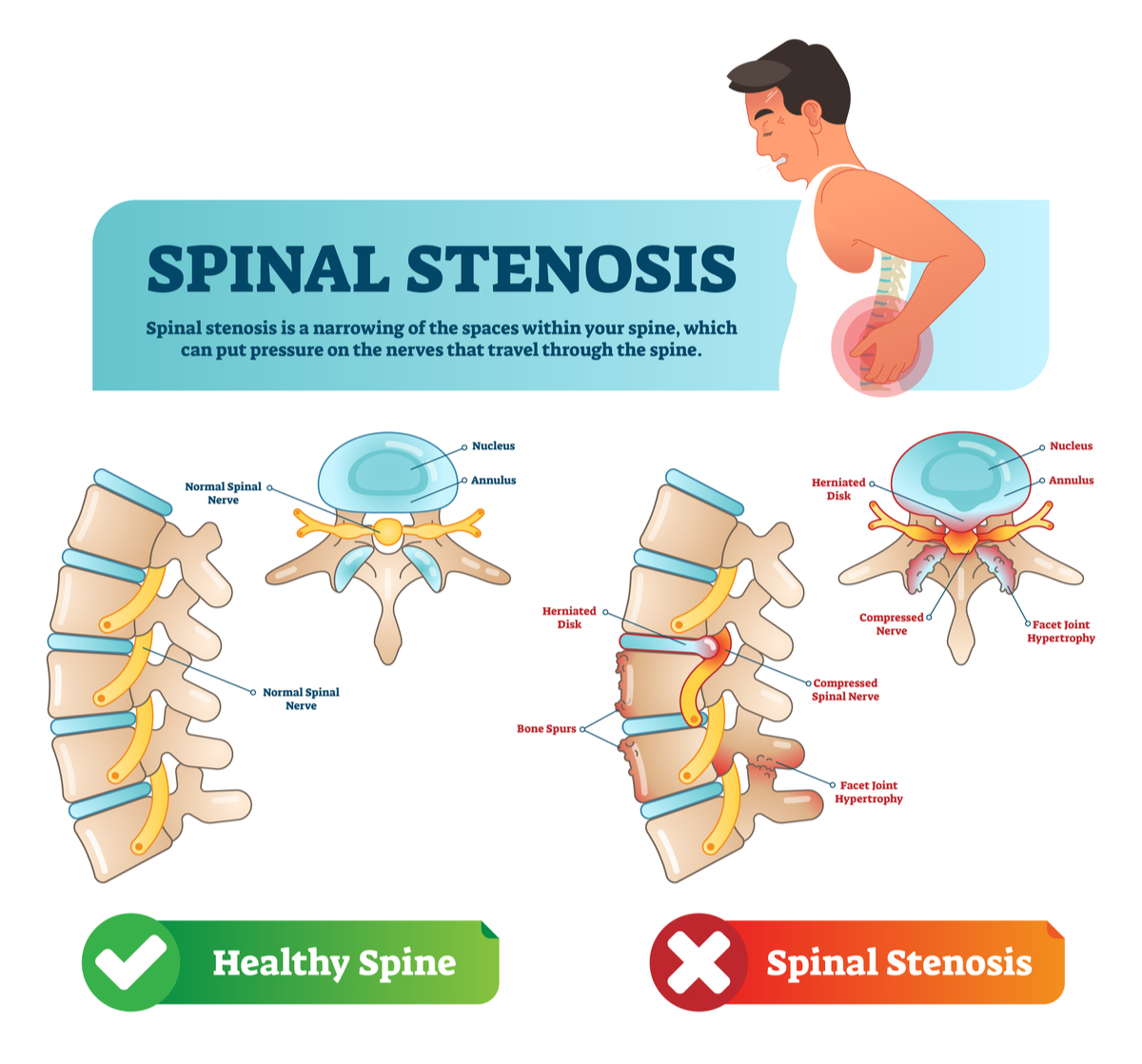 Spinal stenosis vector illustration. Labeled medical scheme with explanation. Diagram with normal spinal nerve, nucleus, annulus, bone spurs and compressed spinal nerve. Cause of back and neck pain